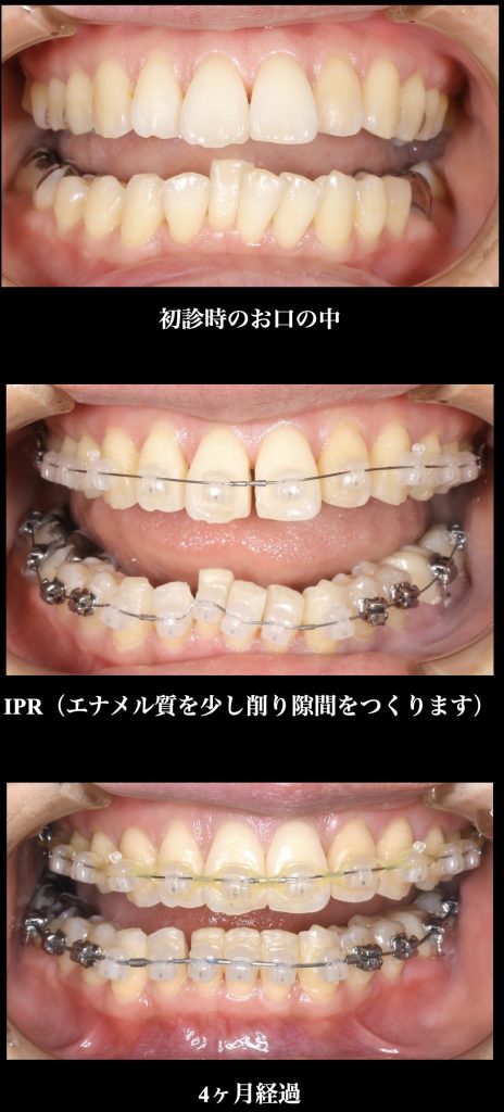 矯正治療の途中経過 こまつ歯科医院 ブログ